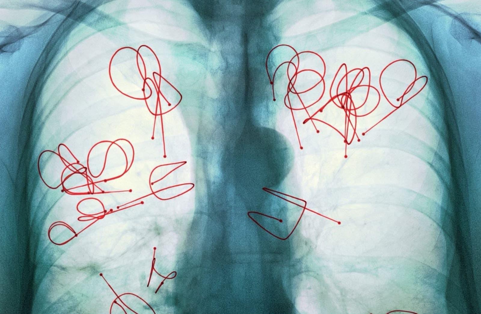 Endobronchial Coil Treatment