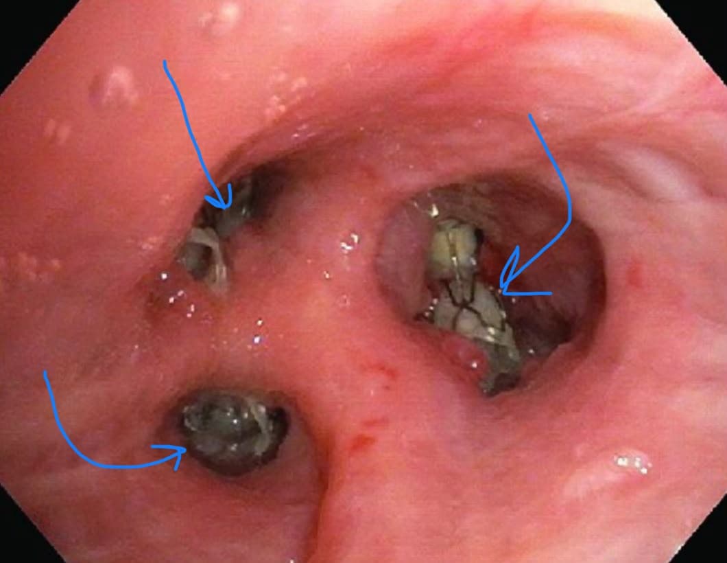 Endobronchial Valve Therapy