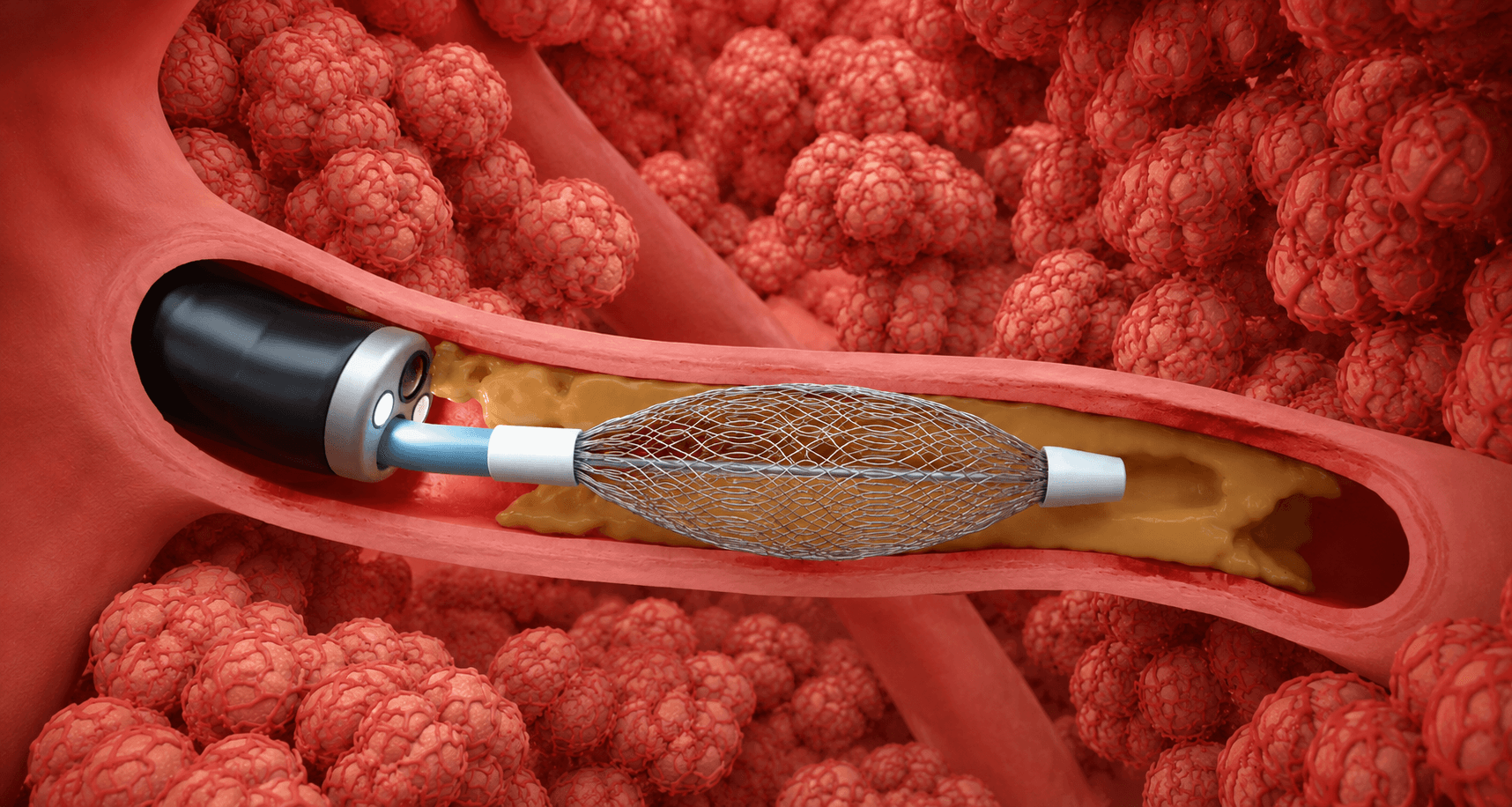 Bronchial Rheoplasty (PEF)