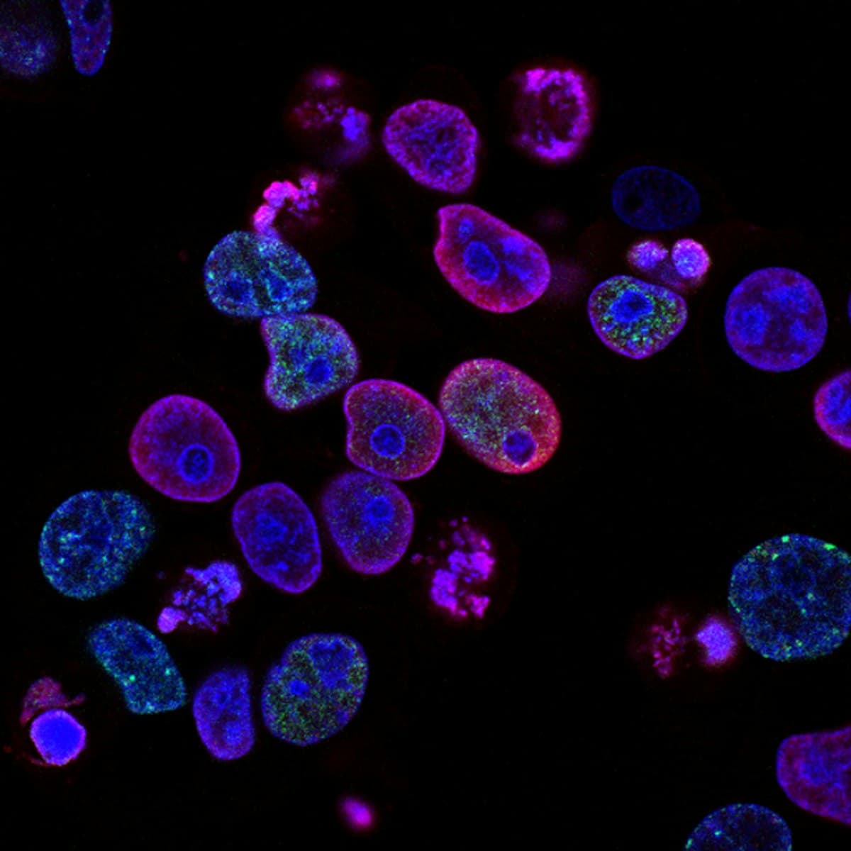 Stem Cell Therapy for COPD