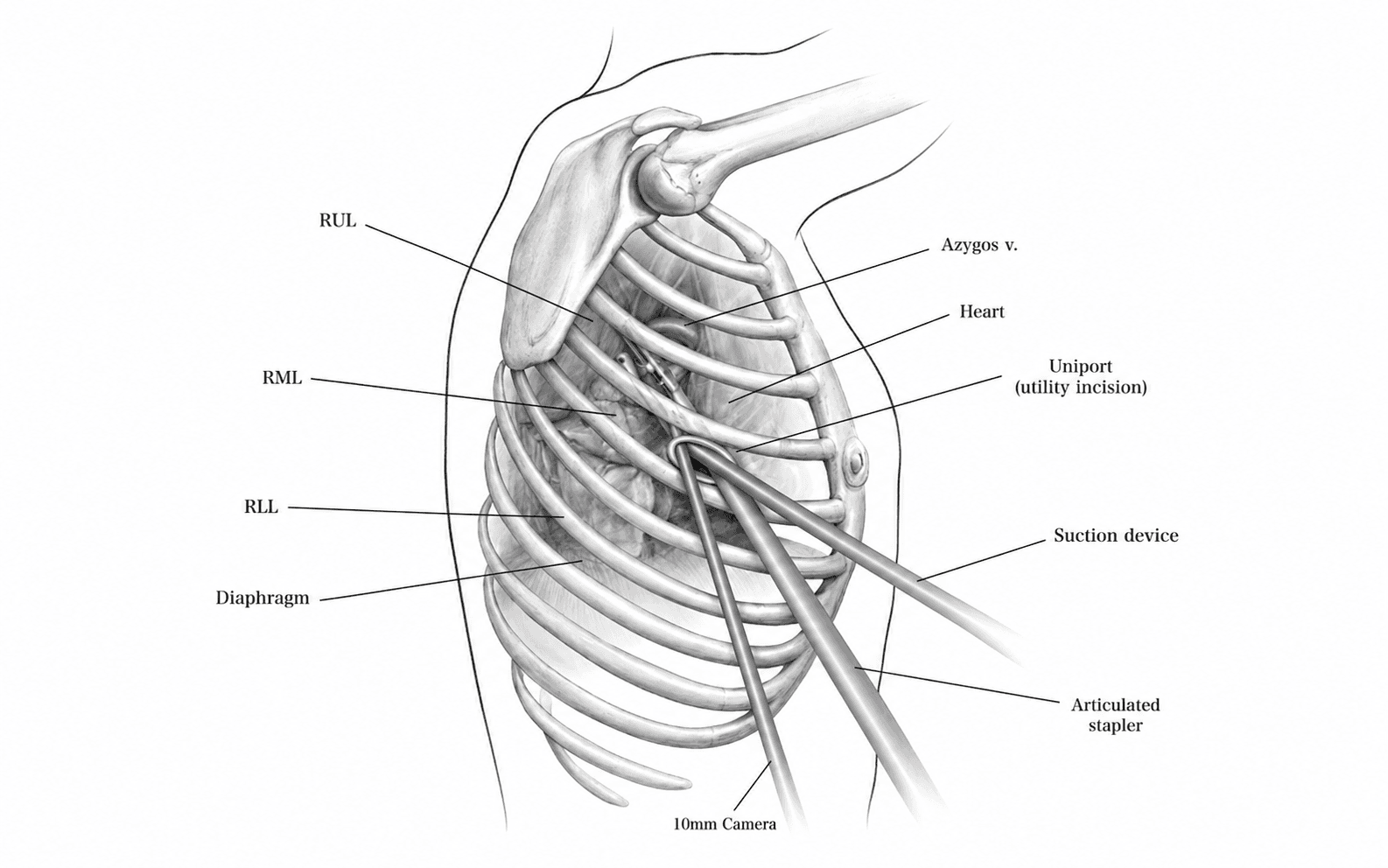 VATS Lung Cancer Surgery